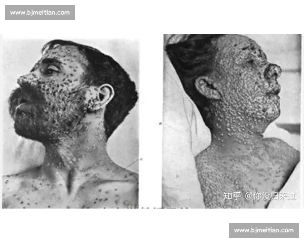 猴痘疫情防控与全球传播现状分析及应对策略探讨 猴痘疫情防控与全球传播现状分析及应对策略探讨